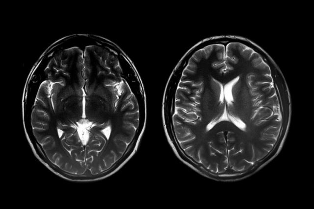 Two Brain Scans 777x518